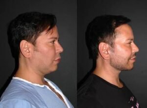 Facelift